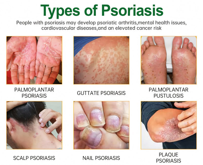 Cvreoz® Knotaway Psoriasis Cream🔥LIMITED SALE: 60% OFF🔥