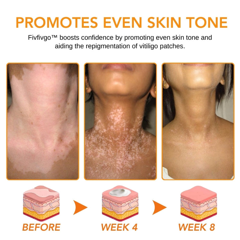 Fivfivgo™ Snake Venom Vitiligo Treatment Cream