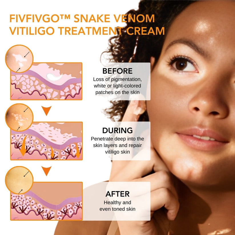 Fivfivgo™ Snake Venom Vitiligo Treatment Cream