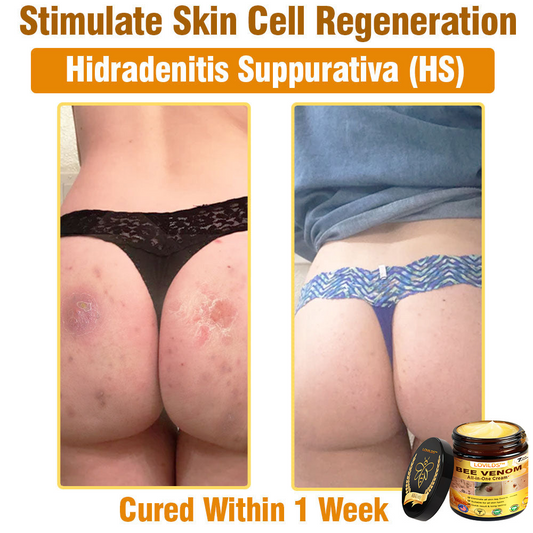 LOVILDS™ 🐝🐝Bee Venom All-in-One Cream US Dermatologist Approved