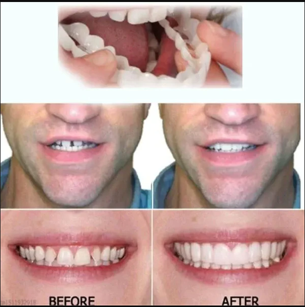 💝Last day discount-48%Off💝Latest👨‍⚕Adjustable Snap-On Dentures😁